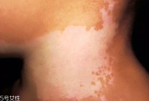 痣什么情況下會轉變為瘤？點痣不可取