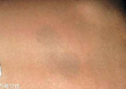 痣什么情況下會轉變為瘤？點痣不可取