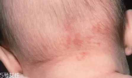 痣什么情況下會轉變為瘤？點痣不可取