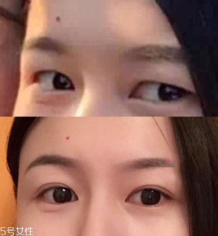 內(nèi)雙怎么進(jìn)化成雙眼皮？全是雙眼皮貼的功勞