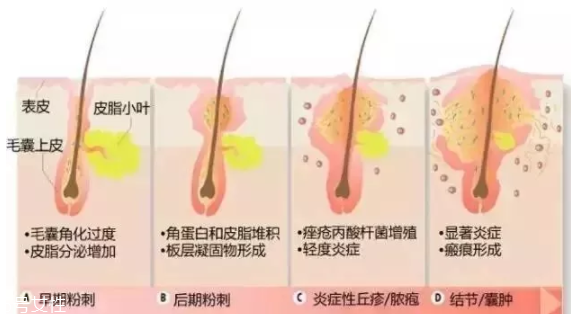 封閉性粉刺的發病機制是什么？角質層太厚