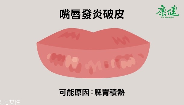 ?嘴唇發黑發紫是什么原因 6種唇色解讀