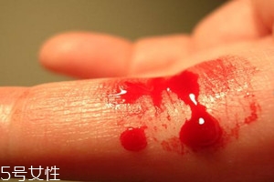 血友病的主要表現有哪些？出血是最明顯的特征