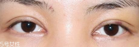 怎么縮短開眼角疤痕消失時間？雙眼皮開眼角恢復過程