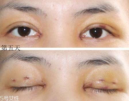 怎么縮短開眼角疤痕消失時間？雙眼皮開眼角恢復過程