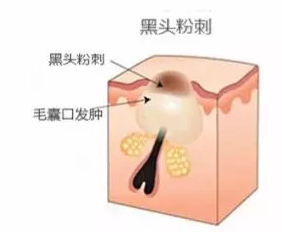 閉口是怎么引起的？4種情況要注意
