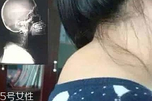 富貴包是什么病？姿態優美少犯病