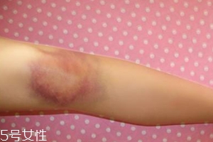 身體淤青怎么來的？不是磕碰那么簡單