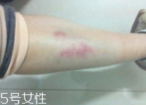 身體淤青怎么來的？不是磕碰那么簡單