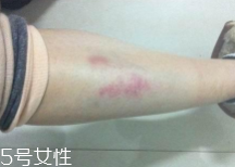 摔傷了涂什么藥好的快？做好消毒才能愈合快