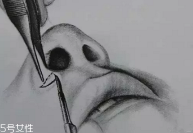 鼻翼外切多久消腫？鼻翼外切消腫時間要多長？