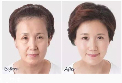 玻尿酸隆鼻怎么樣 玻尿酸隆鼻有什么優勢
