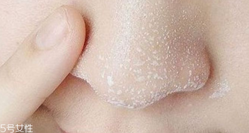 黑頭不管它會變大嗎？黑頭不管它會怎樣？