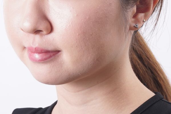 暗瘡怎么能快速消腫 內服外用消滅暗瘡