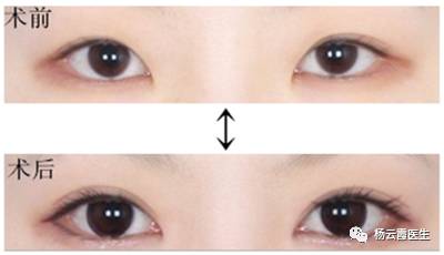 開(kāi)內(nèi)眼角要多少錢(qián) 各地區(qū)不統(tǒng)一