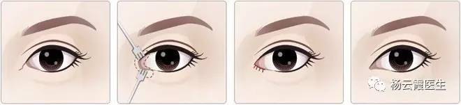 開(kāi)內(nèi)眼角要多少錢(qián) 各地區(qū)不統(tǒng)一