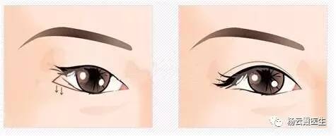開(kāi)內(nèi)眼角要多少錢(qián) 各地區(qū)不統(tǒng)一