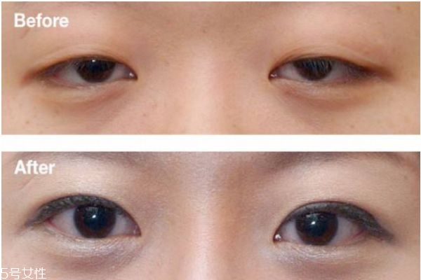 上瞼下垂矯正術治療方式 上瞼下垂矯正術優點和缺點