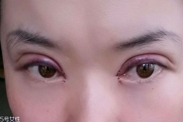 內雙割雙眼皮容易嗎 割雙眼皮有什么注意的呢