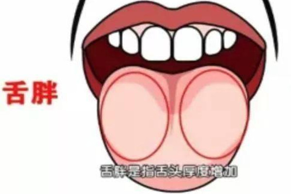 胖大舌是什么 什么情況下會出現胖大舌