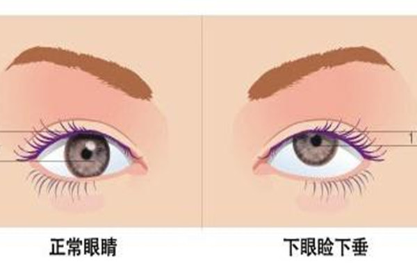 武漢眼瞼下垂手術哪個做的好 武漢眼瞼下垂手術要多少錢