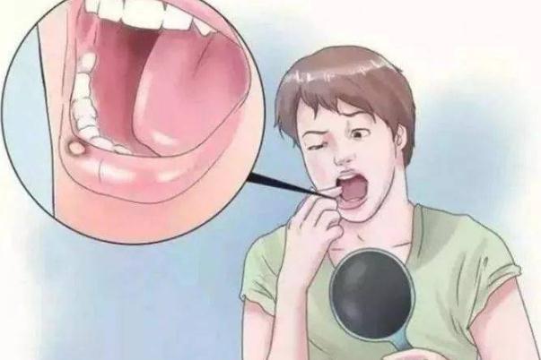 口腔潰瘍反復發作怎么根治 口腔潰瘍反復發作是怎么回事