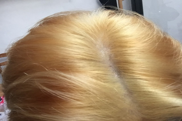 漂頭發頭皮疼正常嗎 漂頭發傷害大嗎