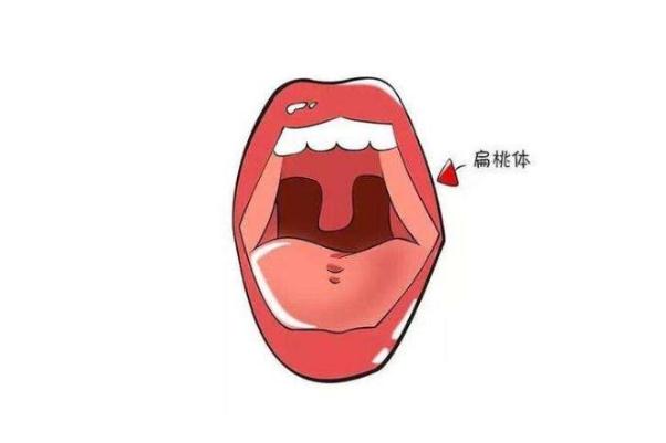 扁桃體發炎吃什么藥比較好 扁桃體發炎喉嚨腫痛怎么辦
