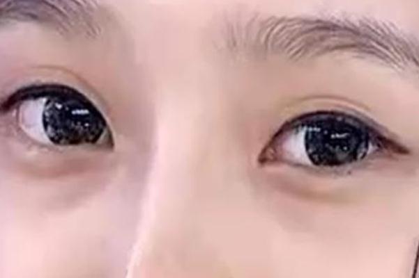 眼袋是脾虛引起的嗎 眼袋是哪個經(jīng)絡堵塞