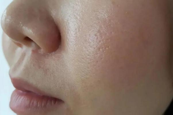 皮膚出油的表現 皮膚出油的好處
