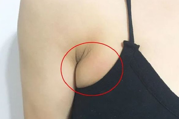 副乳切除手術什么季節做最好 副乳切除手術可以在整形醫院做嗎