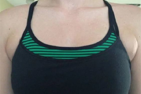 副乳切除手術什么季節做最好 副乳切除手術可以在整形醫院做嗎