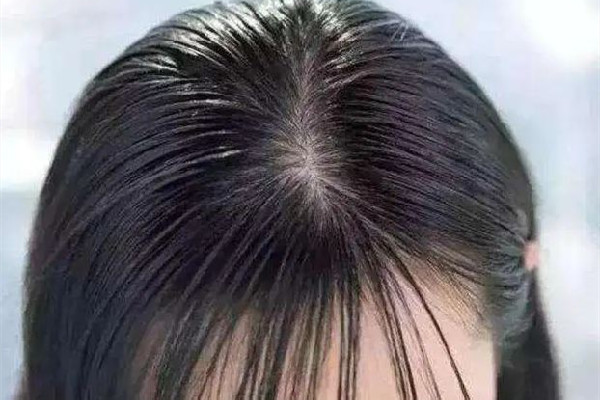 頭發出油要用什么洗發水 頭發出油用香皂洗頭可以嗎
