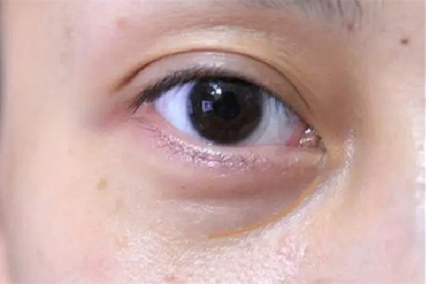 武漢淚溝填充哪家醫院最好 武漢淚溝脂肪填充多少錢