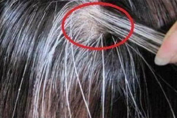 白頭發和性生活頻繁有關系嗎 白頭發是腎陰虛還是腎陽虛